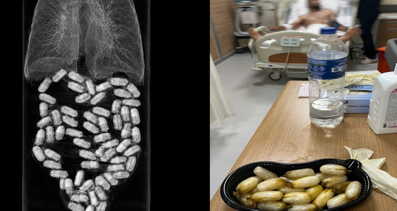 Midesinden 590 gram uyuşturucu çıktı